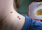 Ada Seperti Ini Tumbuh di Badan Anda? Bumbu Dapur Ini Ampuh Mengusirnya
