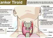 Ini Tanda-tanda Kanker Tiroid yang Perlu Diwaspadai