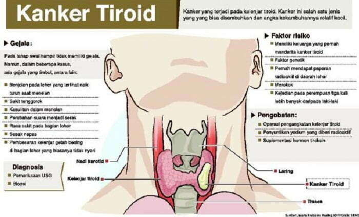 Tanda-tanda Kanker Tiroid yang Perlu Diwaspadai. (Int)