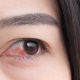 Waspadai Penyakit Mata karena Diabetes: Glaukoma, Katarak, Retinopati Diabetik, dan Edema Makula Diabetik