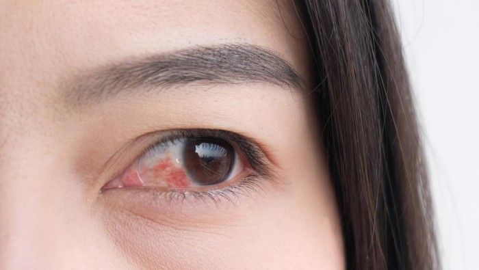 Waspadai Penyakit Mata karena Diabetes: Glaukoma, Katarak, Retinopati Diabetik, dan Edema Makula Diabetik