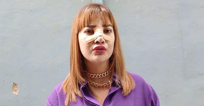Irma Dharmawangsa menjalani operasi hidung di Jakarta Utara